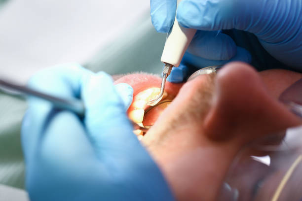 Best Chipped Tooth Repair Near Me  in Rainier, WA